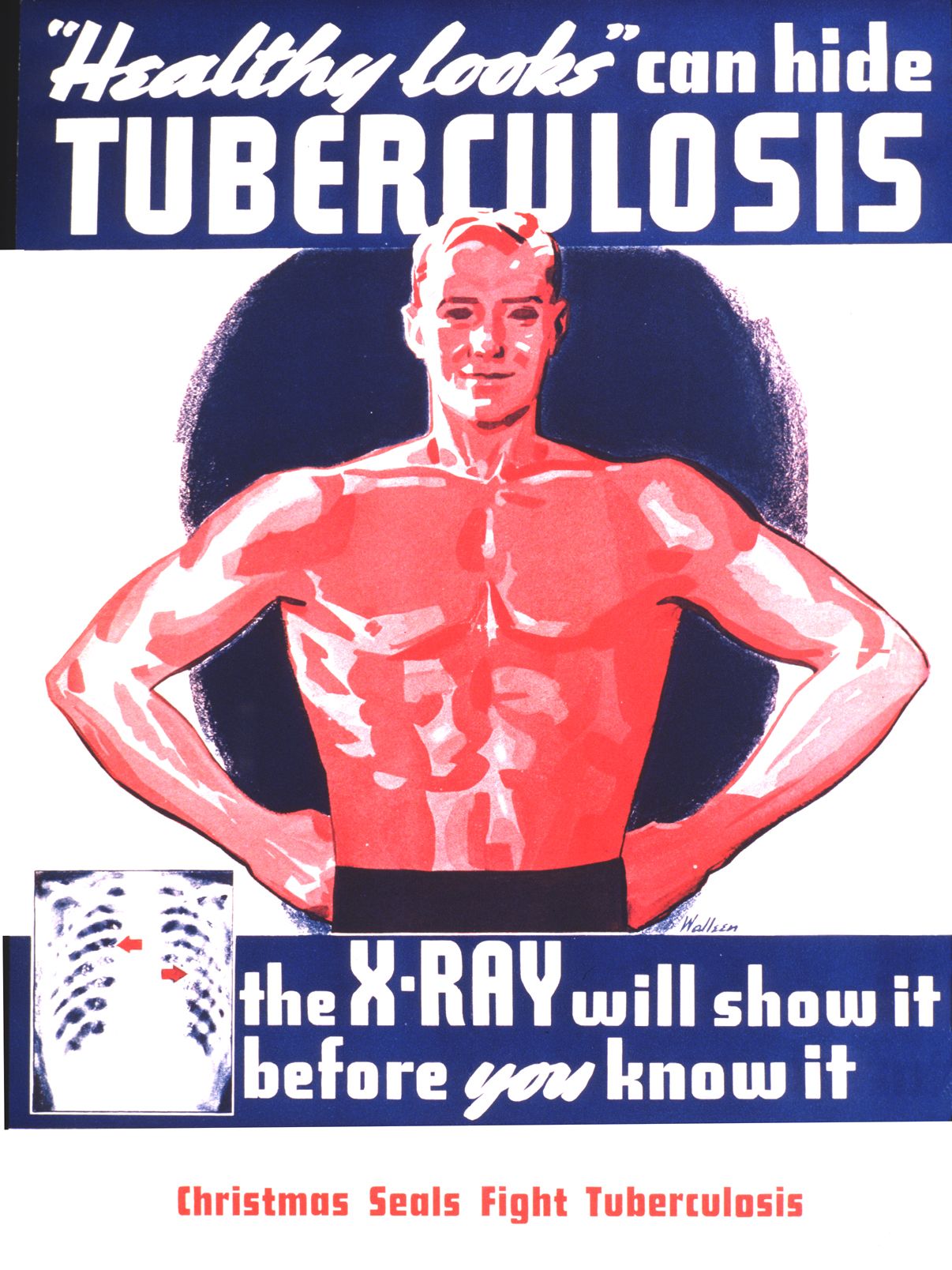 Cartel “Un aspecto saludable puede ocultar la tuberculosis” (hacia 1933). Título original: "Healthy Looks Can Hide Tuberculosis".